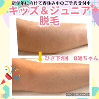 長期期間中は、お子様の脱毛日和です