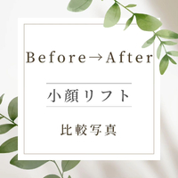 【小顔リフトフェイシャル】